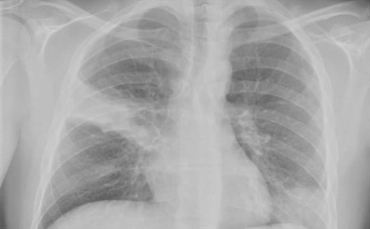 Aspiration pneumonitis